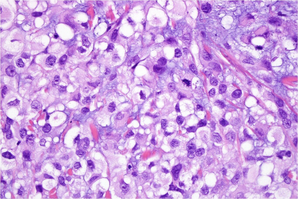 Melanoma mixoide - Il Melanoma