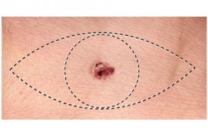 melanoma surgery