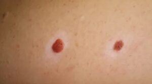 Melanoma congenito o infantile